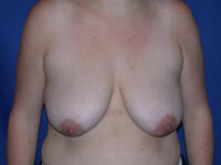 before breast lift | breast lift with implants front view case 2953