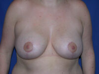 after breast lift | breast lift with implants front view case 2953