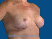 after breast lift | breast lift with implants right angled view case 2985