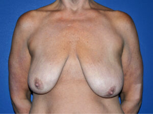 before breast lift | breast lift with implants front view case 2985