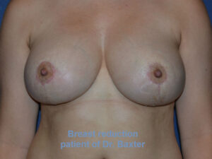 after breast lift | breast lift with implants front view case 2756