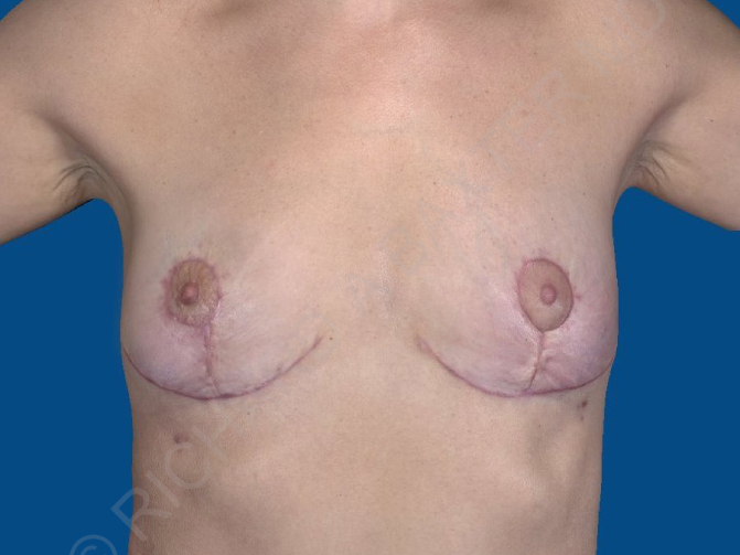 after breast lift | breast lift with implants front view case 2535