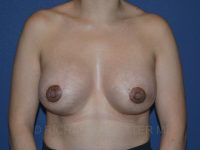 after breast lift with implants front view case 2990