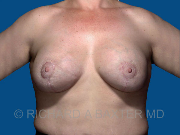 after breast lift with implants front view case 3017
