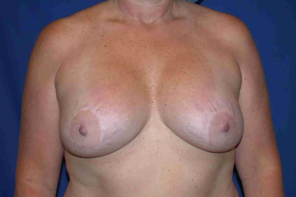 before breast lift with implants front view case 3025