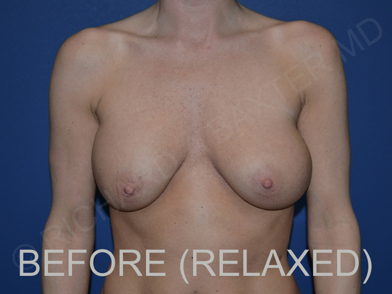 before breast lift with implants while relaxed front view case 3044