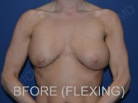 before breast lift with implants while flexing front view case 3044