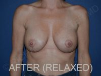 after breast lift with implants while relaxed front view case 3044