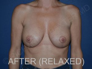 after breast lift with implants while relaxed front view case 3044