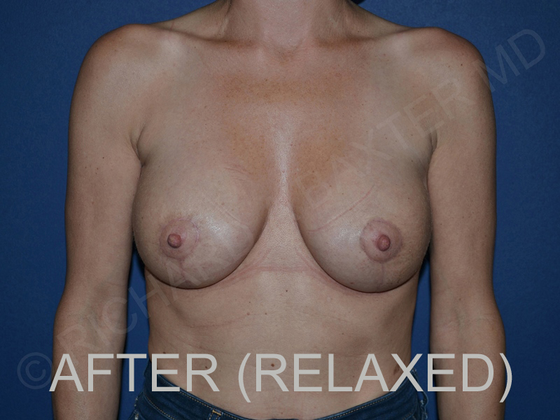 after breast lift with implants while relaxed front view case 3044