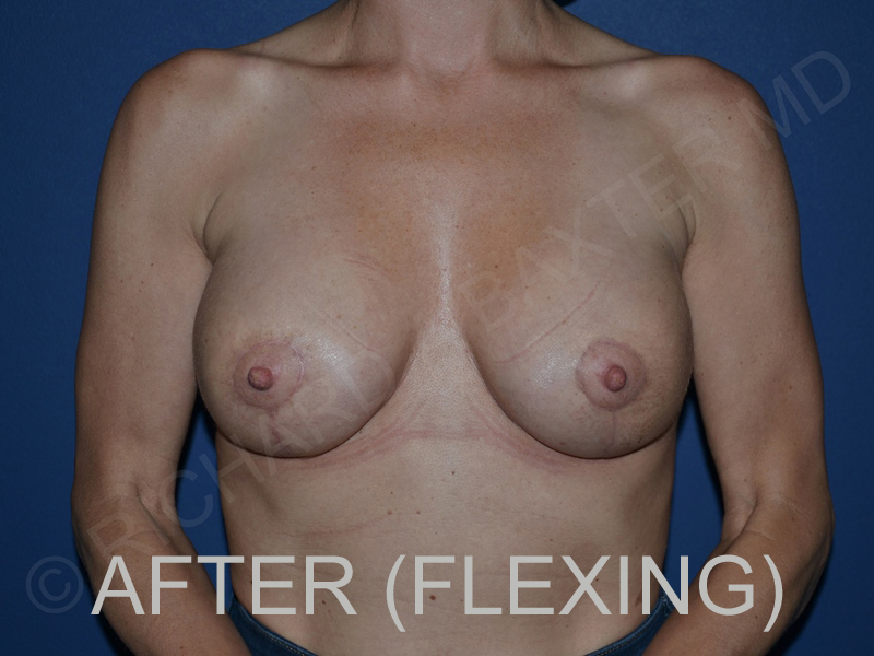 after breast lift with implants while flexing front view case 3044