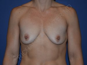 before breast lift with implants front view case 3049