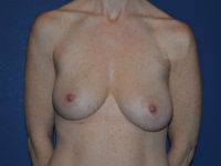 before breast lift with implants front view case 3059
