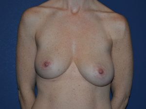 before breast lift with implants front view case 3059