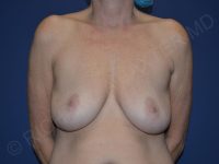 before breast lift with implants front view case 3012