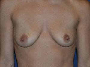 before breast lift with implants front view case 3054