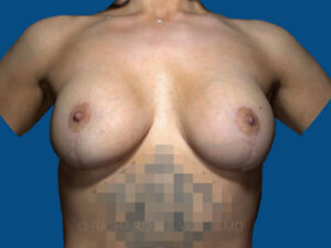 after breast lift with implants front view case 2977
