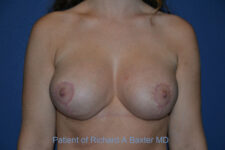 after breast lift with implants front view case 2980