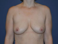 before breast lift with implants front view case 2995