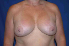 before breast lift with implants front view case 3025
