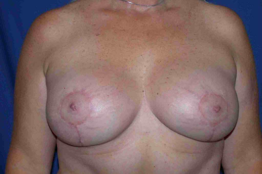 after breast lift with implants front view case 3025