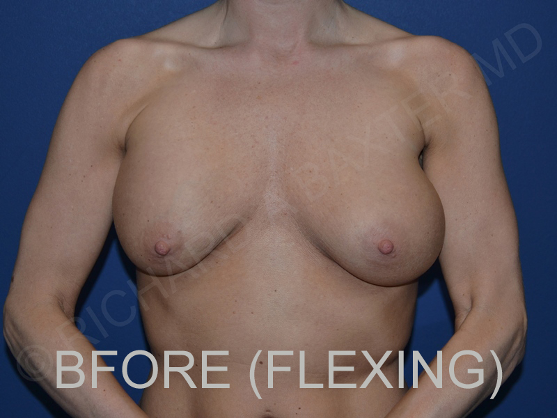before breast lift with implants while flexing front view case 3044