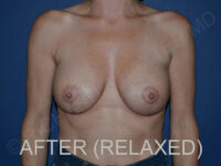 after breast lift with implants while relaxed front view case 3044