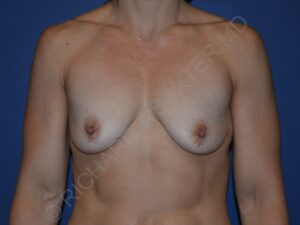 before breast lift with implants front view case 3049
