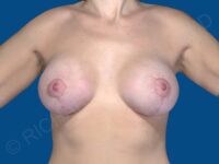 after breast lift with implants front view case 3007