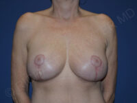 after breast lift with implants front view case 3012
