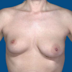 before breast lift with implants front view case 3069
