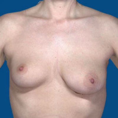 before breast lift with implants front view case 3069