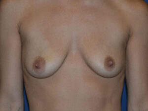 before breast lift with implants front view case 3054