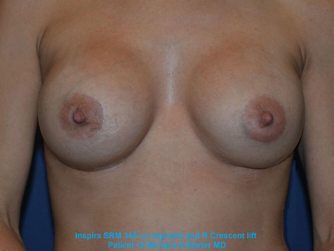 after breast lift with implants front view case 3054