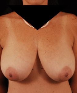 before breast reduction front view case 3618