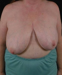 before breast reduction front view case 3630