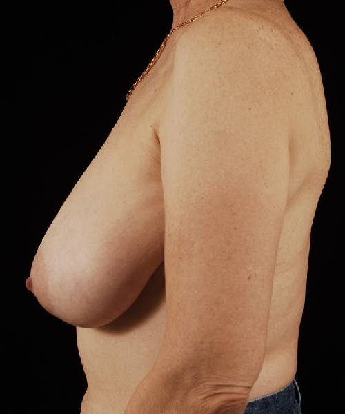 before breast reduction left side view case 3661