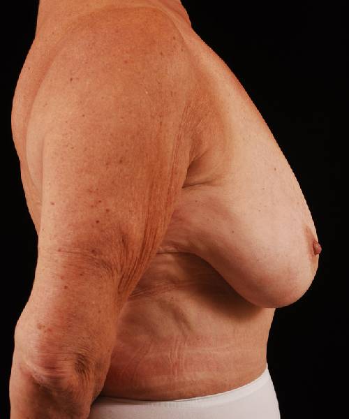 before breast reduction right side view case 3666