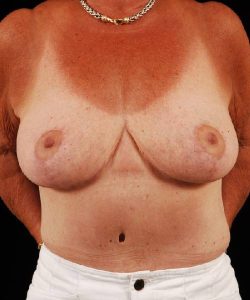 after breast reduction front view case 3666