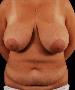 before breast reduction front view case 3673
