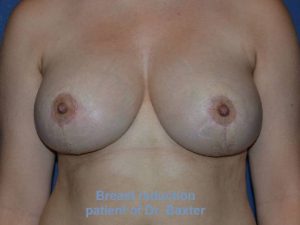 after breast reduction front view case 3594