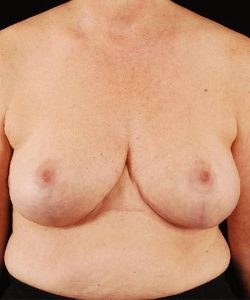 after breast reduction front view case 3635