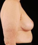 after breast reduction right side view case 3635