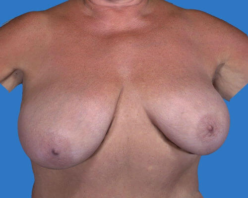 before breast reduction front view case 3599