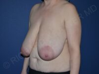 before breast reduction left angled view case 3610