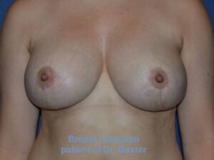 after breast reduction front view case 3594