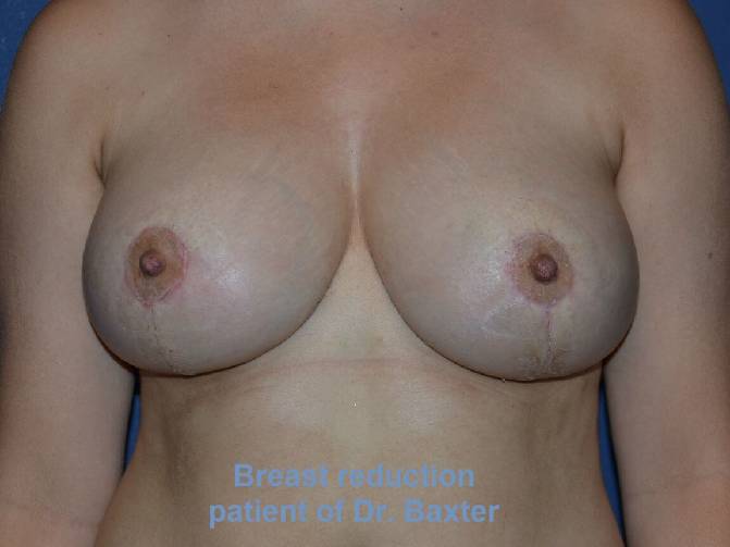after breast reduction front view case 3594