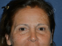 before brow lift female patient front view case 3542