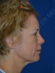 before brow lift female patient right side view case 3552