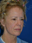 before brow lift female patient right angled view case 3552